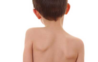 Conoscere e prevenire la scoliosi nei bambini