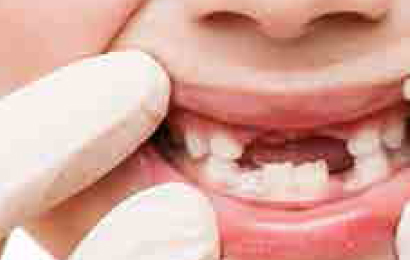 Assenza di uno o più denti… il trattamento delle agenesie dentarie: come, quando e perchè?