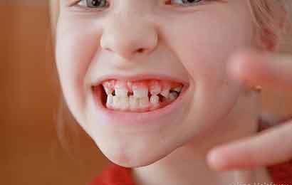 Quali sono i segnali che ci dicono che è ora  di pensare all’apparecchio dei denti?